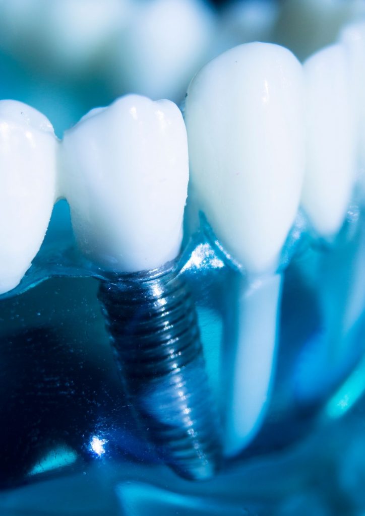Dr VC Bhagwan Dental Implants Pietermaritzburg
